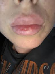does having lip filler make your lips