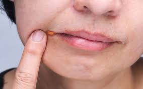 rash around mouth 17 common causes and