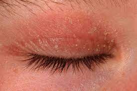 eyelid dermais symptoms causes