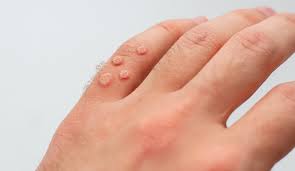 dermatologists remove warts
