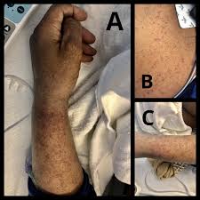 It has a name now: Cureus Purpuric Rash And Thrombocytopenia After The Mrna 1273 Moderna Covid 19 Vaccine