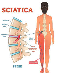 sciatica a pain in the