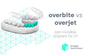 Check spelling or type a new query. Overjet Vs Overbite What Is What And Can Aligners Improve Them