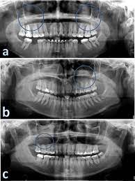 panoramic radiographs with images