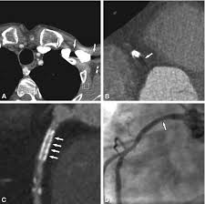 coronary artery stents radiology key