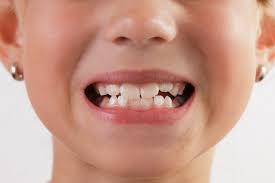 Dental Treatment Guide For Over Retained Teeth In Kids Part I