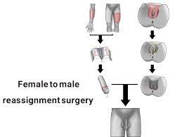 female to male reignment surgery