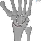 Image result for icd 10 code for scapholunate advanced collapse wrist