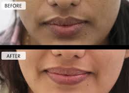 lip lightening treatment cost in