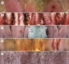 video capsule endoscopy images of