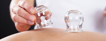 cupping therapy illinois goodlife