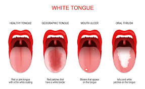 white spots on tongue causes