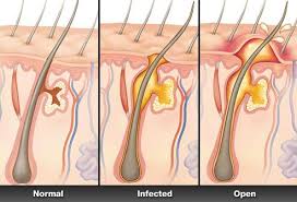 hidradenitis suppurativa treatment dr