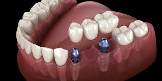dental bridges vs dental implants
