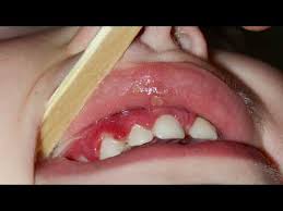 canker soreouth ulcers