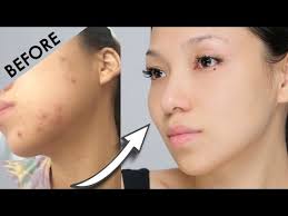 remove acne marks 3 home remes