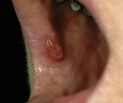 mouth ulcers aphthous stomais