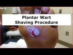 plantar wart shaving procedure you