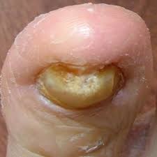 toenail problems toenail fungus