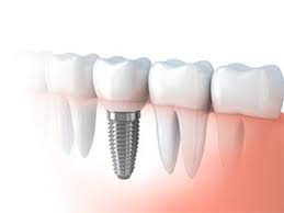 Image result for dental implant