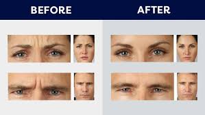 cosmetic uses of botox south bay
