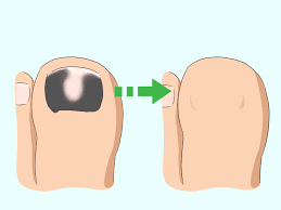 That is the very first sign of an infection under fingernail and it will look some people also end up getting black fungus under toenails and that usually occurs through personal contact. 3 Easy Ways To Treat A Black Toenail Wikihow