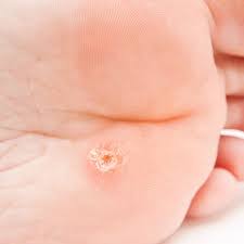 how to get rid of warts naturally