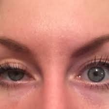 eyelid drops after botox being injected