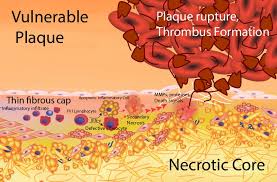 lipoproteins in atherosclerosis