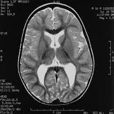 Maybe you would like to learn more about one of these? Neuromotor Spectrum Of Periventricular Leukomalacia In Children Born At Term Pediatric Neurology