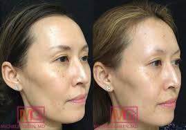 removing sun spots on the face dr