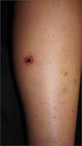 rash on legs and abdomen mdedge