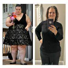 after gastric sleeve bariatric surgery