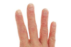 chronic hand dermais a practical
