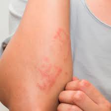 Rashes can appear anywhere on the body, including the butt. Contact Dermatitis Causes Natural Treatments Dr Axe