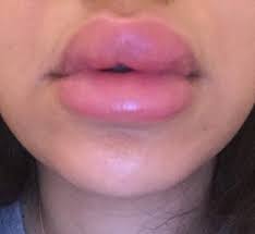 sudden swollen lips after having filler