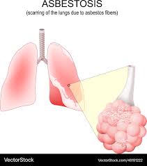 asbestosis lungs close up of alveolus