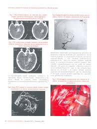 Índice ¿qué es el aneurisma cerebral? Https Silo Tips Download Aneurisma Cerebral En El Interior De Glioblastoma Multiforme