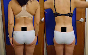 do laser treatments for weight loss
