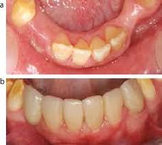 single discoloured tooth part
