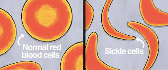 What Is Sickle Cell Disease?