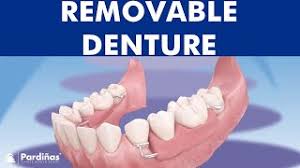 Partial denture consent form spanish : Removable Partial Denture Over Natural Teeth Clinica Pardinas