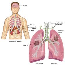 non small cell lung cancer treatment