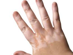 Vitiligo Disease Causes Symptoms And Treatment