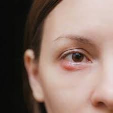 eye infections conjunctivitis stye