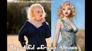 Image result for africa albinos