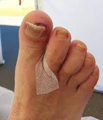 black toenail treatment causes