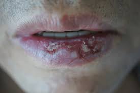 cheilitis overview symptoms causes