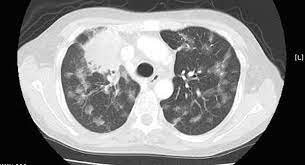 Multiple Lung Metastases Presenting As