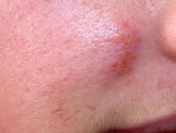 However, an initial infection (perhaps months or years previously) can be asymptomatic and still have symptomatic recurrent outbreaks on the buttocks, upper thighs, etc. Herpes Simplex Dermnet Nz